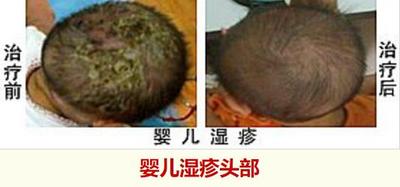 婴儿湿疹.jpg