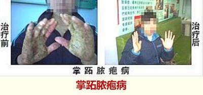 掌跖脓疱病.jpg