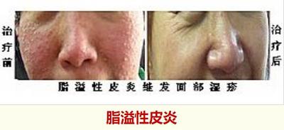 脂溢性皮炎对比图.jpg