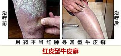 红皮型牛皮癣.jpg