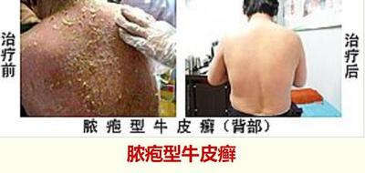 脓疱型牛皮癣.jpg