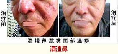 酒精鼻.jpg