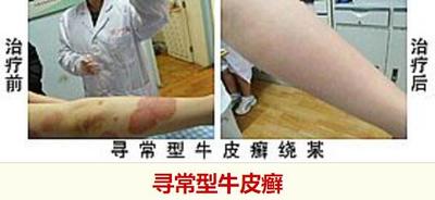 寻常型牛皮癣.jpg
